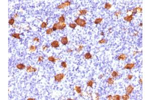 Formalin-fixed, paraffin-embedded human Hodgkin's Lymphoma stained with CD30 Rabbit Polyclonal Antibody. (TNFRSF8 抗体)