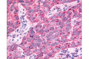 Anti-TAOK1 / TAO1 antibody IHC of human Lung, Non-Small Cell Carcinoma. (TAO Kinase 1 (TAOK1) (Internal Region) 抗体)