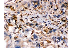 Anti- TAP1 Picoband antibody, IHC(P) IHC(P): Human Intestinal Cancer Tissue (TAP1 抗体  (Middle Region))