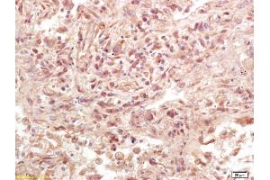 Formalin-fixed and paraffin embedded human lung carcinoma labeled with Anti-Phospho-LAT (Tyr161) Polyclonal Antibody, Unconjugated (ABIN1386362) at 1:200 followed by conjugation to the secondary antibody and DAB staining.