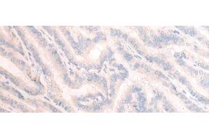 Immunohistochemistry of paraffin-embedded Human thyroid cancer tissue using TBC1D2 Polyclonal Antibody at dilution of 1:25(x200) (TBC1D2 抗体)