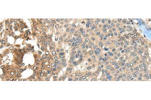 Immunohistochemistry of paraffin-embedded Human liver cancer tissue using MAPK4 Polyclonal Antibody at dilution of 1:35(x200) (MAPK4 抗体)