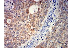 Immunohistochemical analysis of paraffin-embedded stomach cancer tissues using GRM5 mouse mAb with DAB staining. (Metabotropic Glutamate Receptor 5 抗体  (AA 458-580))