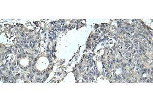 Immunohistochemistry of paraffin-embedded Human colorectal cancer tissue using SLC35F6 Polyclonal Antibody at dilution of 1:95(x200) (SLC35F6 抗体)