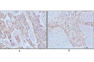 Immunohistochemical analysis of paraffin-embedded human breast cancer,Lung breast tissues using EGF antibody (EGF 抗体)