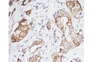 IHC-P: IGF-1 antibody testing of human breast cancer tissue (IGF1 抗体  (Middle Region))