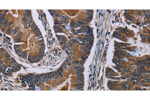 Immunohistochemistry of paraffin-embedded Human colon cancer using SLC1A6 Polyclonal Antibody at dilution of 1:40