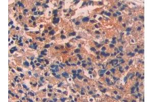 DAB staining on IHC-P; Samples: Human Prostate cancer Tissue (ECT2 抗体  (AA 453-647))