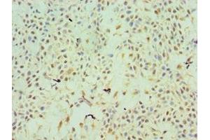 Immunohistochemistry of paraffin-embedded human breast cancer using ABIN7172211 at dilution of 1:100 (TFPI2 抗体  (AA 23-235))