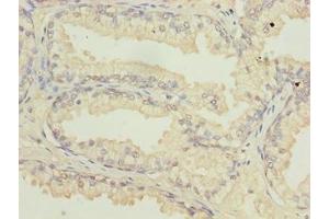 Immunohistochemistry of paraffin-embedded human prostate cancer using ABIN7144813 at dilution of 1:100 (ATL2 抗体  (AA 1-300))