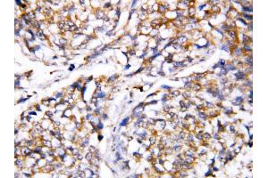 Anti-Caspase 4 antibody, IHC(P) IHC(P): Human Mammary Cancer Tissue (Caspase 4 抗体  (N-Term))