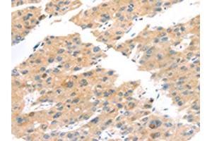The image on the left is immunohistochemistry of paraffin-embedded Human liver cancer tissue using ABIN7192841(TNK1 Antibody) at dilution 1/20, on the right is treated with synthetic peptide. (TNK1 抗体)