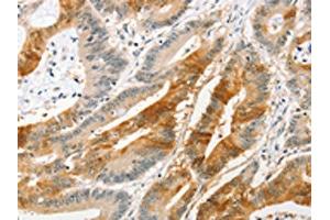 The image on the left is immunohistochemistry of paraffin-embedded Human colon cancer tissue using ABIN7128400(ANAPC2 Antibody) at dilution 1/20, on the right is treated with fusion protein. (ANAPC2 抗体)