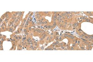 Immunohistochemistry of paraffin-embedded Human thyroid cancer tissue using PPP3R1 Polyclonal Antibody at dilution of 1:55(x200) (PPP3R1 抗体)