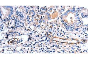 Immunohistochemistry of paraffin-embedded Human stomach cancer using COX11 Polyclonal Antibody at dilution of 1:30 (COX11 抗体)