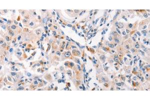 Immunohistochemistry of paraffin-embedded Human liver cancer tissue using MUC2 Polyclonal Antibody at dilution 1:60 (MUC2 抗体)