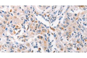 Immunohistochemistry of paraffin-embedded Human liver cancer tissue using MUC2 Polyclonal Antibody at dilution 1:60 (MUC2 抗体)