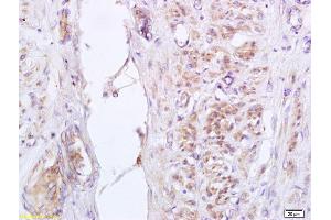 Formalin-fixed and paraffin embedded human cervical carcinoma labeled with Anti-phospho-GADD153 (Ser30) Polyclonal Antibody, Unconjugated (ABIN755977) at 1:200 followed by conjugation to the secondary antibody and DAB staining (DDIT3 抗体  (pSer30))