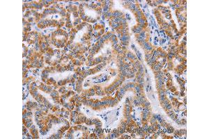 Immunohistochemistry of Human cervical cancer using BST1 Polyclonal Antibody at dilution of 1:50 (BST1 抗体)