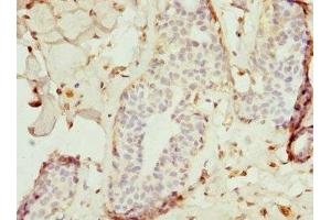 Immunohistochemistry of paraffin-embedded human breast cancer using ABIN7172240 at dilution of 1:100 (TRAF4 抗体  (AA 251-470))