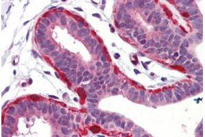 Human Breast (formalin-fixed, paraffin-embedded) stained with SNCG antibody ABIN364362 at 5 ug/ml followed by biotinylated goat anti-rabbit IgG secondary antibody ABIN481713, alkaline phosphatase-streptavidin and chromogen. (SNCG 抗体)