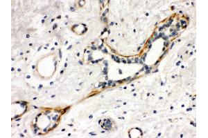 Anti- YES1 Picoband antibody,IHC(P) IHC(P): Human Mammary Cancer Tissue (YES1 抗体  (N-Term))
