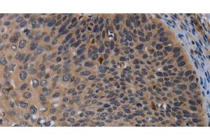 Immunohistochemistry of paraffin-embedded Human cervical cancer using P2RX2 Polyclonal Antibody at dilution of 1:50 (P2RX2 抗体)