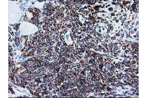 Immunohistochemical staining of paraffin-embedded Adenocarcinoma of Human breast tissue using anti-ALDH3A2 mouse monoclonal antibody. (ALDH3A2 抗体)