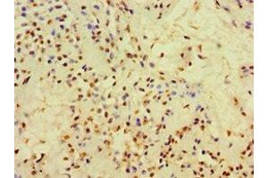Immunohistochemistry of paraffin-embedded human breast cancer using ABIN7148384 at dilution of 1:100 (Adipsin 抗体  (AA 26-253))