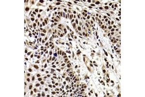 Immunohistochemistry of paraffin-embedded human well-differentiated squamous skin carcinoma using HIRIP3 antibody (ABIN6128019, ABIN6141779, ABIN6141780 and ABIN6222788) at dilution of 1:100 (40x lens). (HIRIP3 抗体  (AA 417-556))
