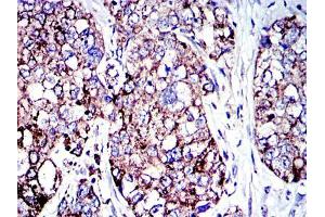 Immunohistochemical analysis of paraffin-embedded human lung cancer tissues using AIF mouse mAb with DAB staining.