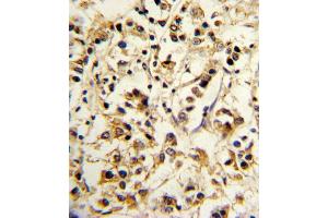 Formalin-fixed and paraffin-embedded human breast carcinoma reacted with KIR2DL4 Antibody (C-term), which was peroxidase-conjugated to the secondary antibody, followed by DAB staining. (KIR2DL4/CD158d 抗体  (C-Term))