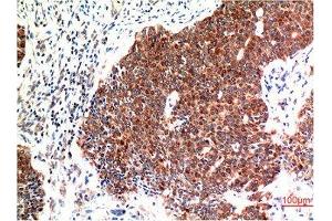 Immunohistochemical analysis of paraffin-embedded Human Breast Carcinoma Tissue using Beclin-1 Mouse mAb diluted at 1:200. (Beclin 1 抗体)