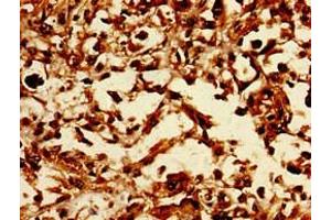 Immunohistochemistry of paraffin-embedded human melanoma using ABIN7147471 at dilution of 1:100 (LASS5 抗体  (AA 332-392))