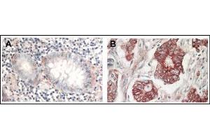 AP22624PU-N AKT antibody staining of Formalin-Fixed Paraffin-Embedded Sections at 1/1,000 dilution: Panel A: Normal colon tissue Panel B: Tumor tissue. (AKT1 抗体  (C-Term))