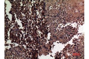 Immunohistochemistry (IHC) analysis of paraffin-embedded Human Lung Cancer, antibody was diluted at 1:100. (MMP12 抗体  (Internal Region))