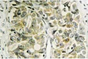 Immunohistochemistry (IHC) analyzes of Galectin-8 antibody in paraffin-embedded human prostate carcinoma tissue. (LGALS8 抗体)