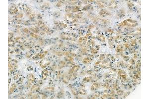 ABIN6265851 and ABIN6278192 at 1/100 staining human renal cell carcinoma by IHC-P.