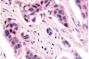 Anti-CDK12 / CRKRS antibody  ABIN1048422 IHC staining of human breast carcinoma. (CDK12 抗体  (Internal Region))