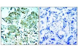Immunohistochemical analysis of paraffin-embedded human breast carcinoma tissue, using (EGFR 抗体)