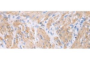 Immunohistochemistry of paraffin-embedded Human gastric cancer tissue using FBXO45 Polyclonal Antibody at dilution of 1:40(x200) (FBXO45 抗体)