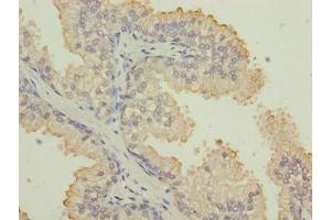 Immunohistochemistry of paraffin-embedded human prostate cancer using ABIN7157360 at dilution of 1:100 (Keratin 33B 抗体  (AA 1-404))