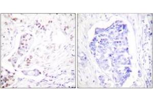 Immunohistochemistry analysis of paraffin-embedded human breast carcinoma tissue, using Cyclin A1 Antibody. (Cyclin A1 抗体  (AA 411-460))