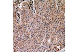Immunohistochemical analysis of ANAPC1 (pS688) staining in human breast cancer formalin fixed paraffin embedded tissue section. (APC1 抗体  (pSer688))