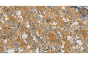 Immunohistochemistry of paraffin-embedded Human breast cancer using PLPP1 Polyclonal Antibody at dilution of 1:40 (PLPP1 抗体)