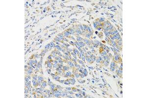 Immunohistochemistry of paraffin-embedded human esophageal cancer using SH2B1 Antibody (ABIN1876744) at dilution of 1:100 (40x lens). (SH2B1 抗体)