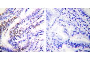 Peptide - +Immunohistochemical analysis of paraffin-embedded human lung carcinoma tissue using Cyclinantibody.