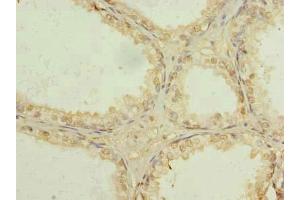 Immunohistochemistry of paraffin-embedded human prostate cancer using ABIN7174340 at dilution of 1:100 (USP47 抗体  (AA 1-157))