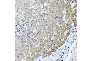Immunohistochemistry of paraffin-embedded human colon carcinoma using PPOX antibody at dilution of 1:100 (x40 lens). (PPOX 抗体)