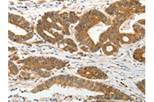 The image on the left is immunohistochemistry of paraffin-embedded Human colon cancer tissue using ABIN7131078(SLC12A1 Antibody) at dilution 1/15, on the right is treated with fusion protein. (SLC12A1 抗体)